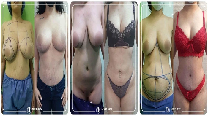 صور قبل وبعد نحت في مشهد